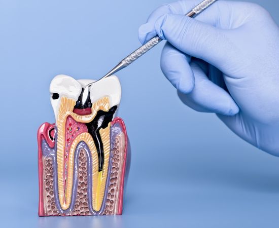 mouth gel for dry mouth