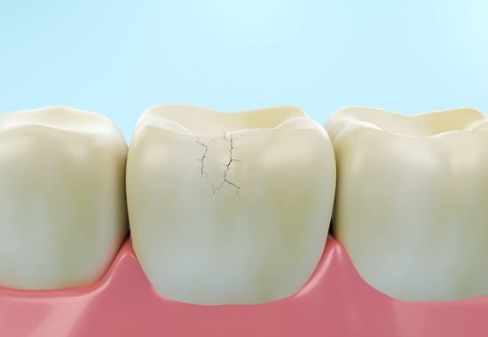 hairline crack in tooth symptoms