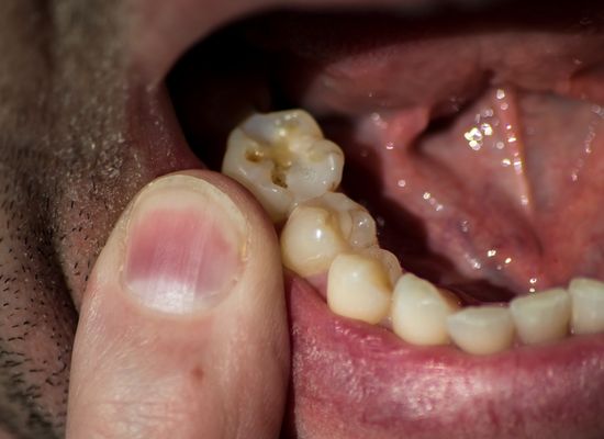 cavity filling fell out