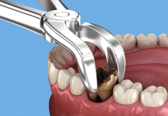 jaw soreness after tooth extraction