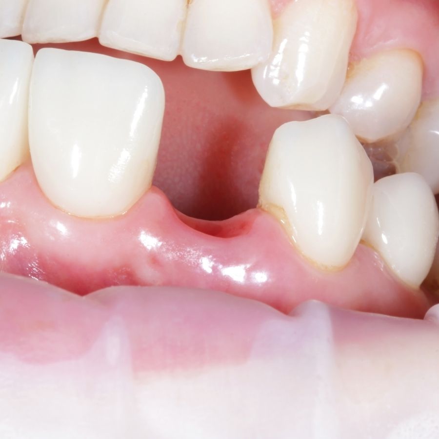 normal socket after tooth extraction