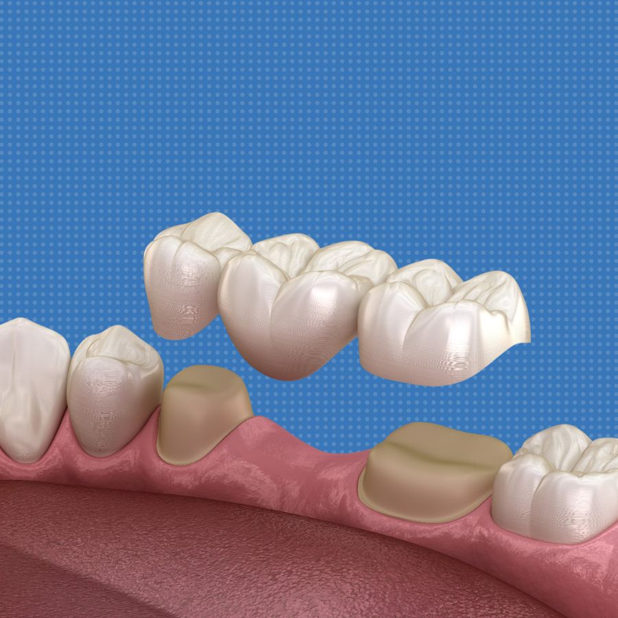 dental bridges